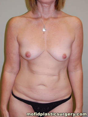 Breast Augmentation