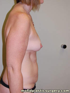 Breast Augmentation