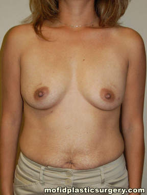 Breast Augmentation Case 3155 Before Photo Breast Augmentation