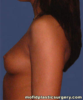 Breast Augmentation