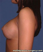 Breast Augmentation