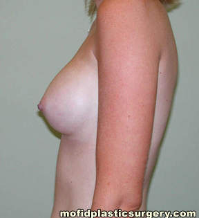 Breast Augmentation Case 3177 After Photo Breast Augmentation