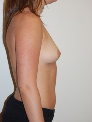 Breast Augmentation Case 3211 Before Photo Breast Augmentation