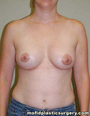 Breast Augmentation Case 3219 After Photo Breast Augmentation