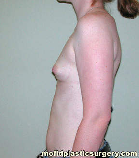 Breast Augmentation Case 3243 Before Photo Breast Augmentation