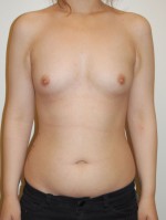 Breast Augmentation