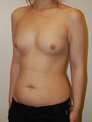 Breast Augmentation Case 3251 Before Photo Breast Augmentation