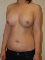 Breast Augmentation