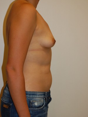 Breast Augmentation Case 3259 Before Photo Breast Augmentation