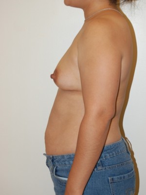 Breast Augmentation Case 3275 Before Photo Breast Augmentation