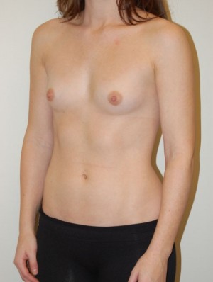 Breast Augmentation Case 3291 Before Photo Breast Augmentation