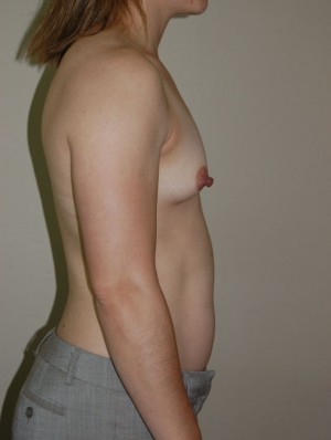 Breast Augmentation Case 3307 Before Photo Breast Augmentation