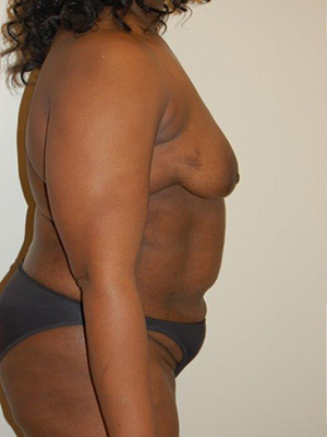 Breast Augmentation with Lift Case 3316 Before Photo Breast Augmentation with Lift