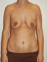 Breast Augmentation with Lift