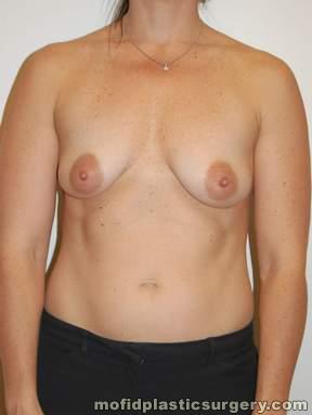 Breast Augmentation with Lift Case 3366 Before Photo Breast Augmentation with Lift