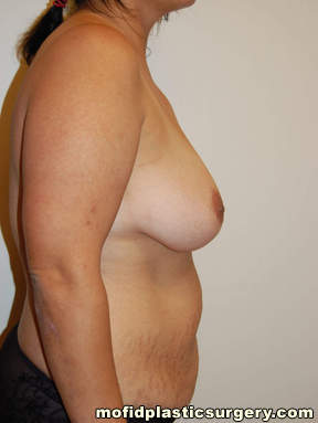 Breast Augmentation with Lift Case 3376 Before Photo Breast Augmentation with Lift