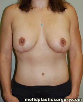 Breast Augmentation with Lift Case 3394 After Photo Breast Augmentation with Lift