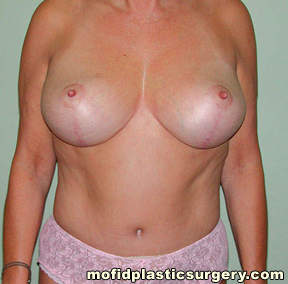 Breast Augmentation with Lift Case 3426 After Photo Breast Augmentation with Lift