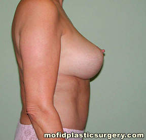 Breast Augmentation with Lift Case 3426 After Photo Breast Augmentation with Lift