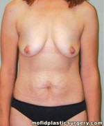 Breast Augmentation with Lift