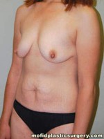 Breast Augmentation with Lift