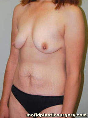 Breast Augmentation with Lift