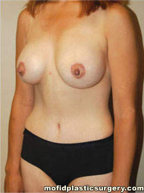 Breast Augmentation with Lift