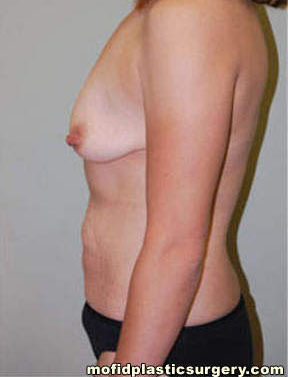 Breast Augmentation with Lift