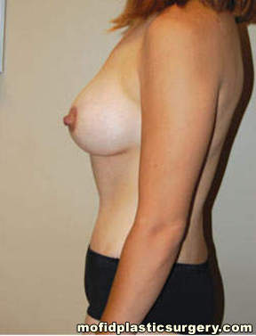 Breast Augmentation with Lift