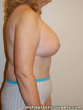 Breast Augmentation with Lift Case 3450 After Photo Breast Augmentation with Lift