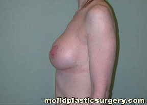 Breast Augmentation with Lift Case 3458 After Photo Breast Augmentation with Lift