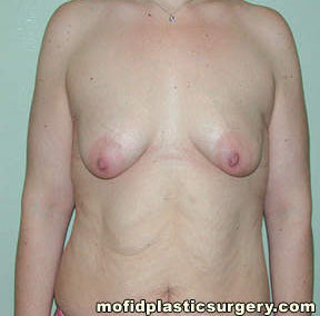 Breast Augmentation with Lift Case 3466 Before Photo Breast Augmentation with Lift