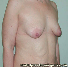 Breast Augmentation with Lift Case 3466 Before Photo Breast Augmentation with Lift