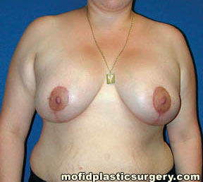 Breast Augmentation with Lift Case 3474 After Photo Breast Augmentation with Lift