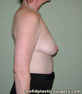 Breast Augmentation with Lift Case 3494 Before Photo Breast Augmentation with Lift