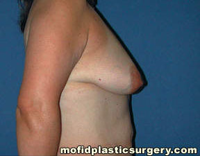 Breast Augmentation with Lift Case 3502 Before Photo Breast Augmentation with Lift