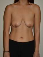 Breast Augmentation with Lift