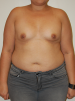 Breast Augmentation with Lift