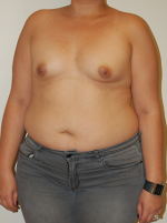 Breast Augmentation with Lift