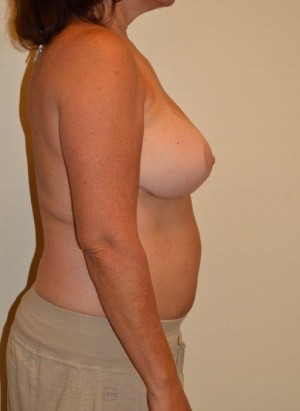 Breast Augmentation with Lift