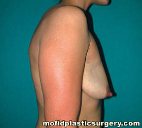 Breast Augmentation with Lift Case 3566 Before Photo Breast Augmentation with Lift