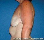 Breast Augmentation with Lift