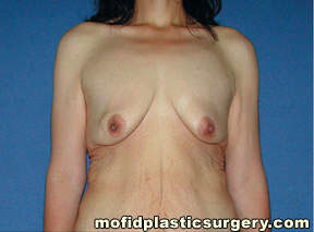 Breast Augmentation with Lift