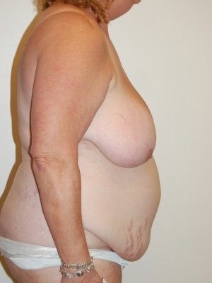 Breast Lift Case 3609 Before Photo Breast Lift