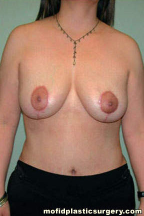 Breast Lift Case 3633 After Photo Breast Lift