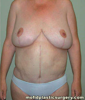 Breast Lift Case 3645 After Photo Breast Lift