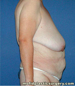 Breast Lift Case 3645 Before Photo Breast Lift