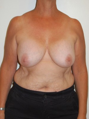 Breast Lift Case 3659 Before Photo Breast Lift