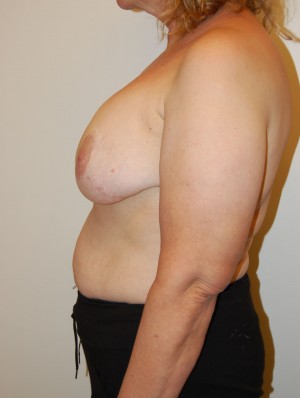 Breast Lift Case 3675 Before Photo Breast Lift