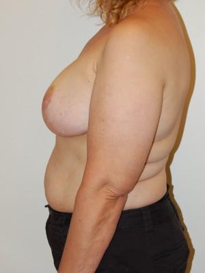 Breast Lift Case 3675 After Photo Breast Lift